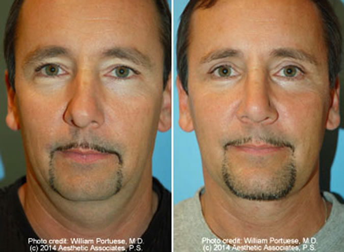 Rhinoplasty Anchorage AK